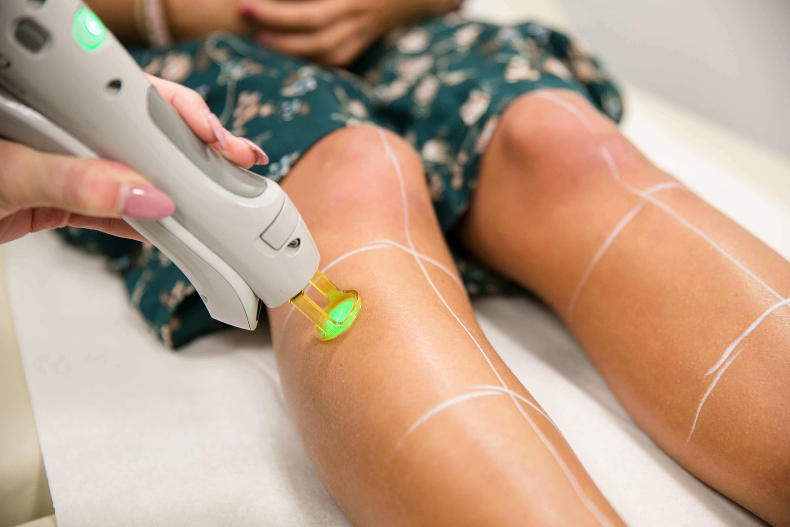 4 Secrets to Successful Laser Hair Removal